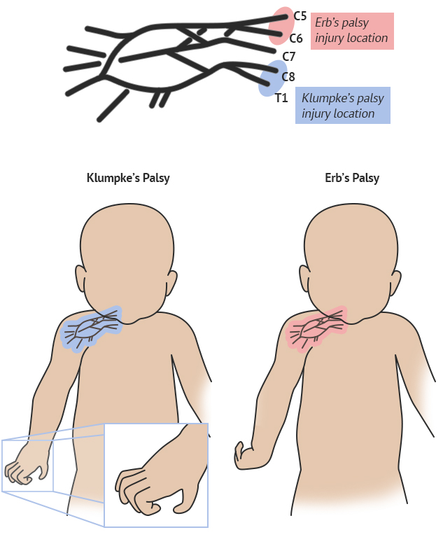 diagram of klumpke's and erb's palsy