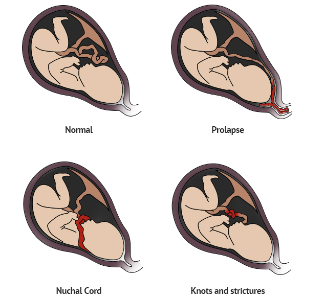 diagrams of umbilical cord complications